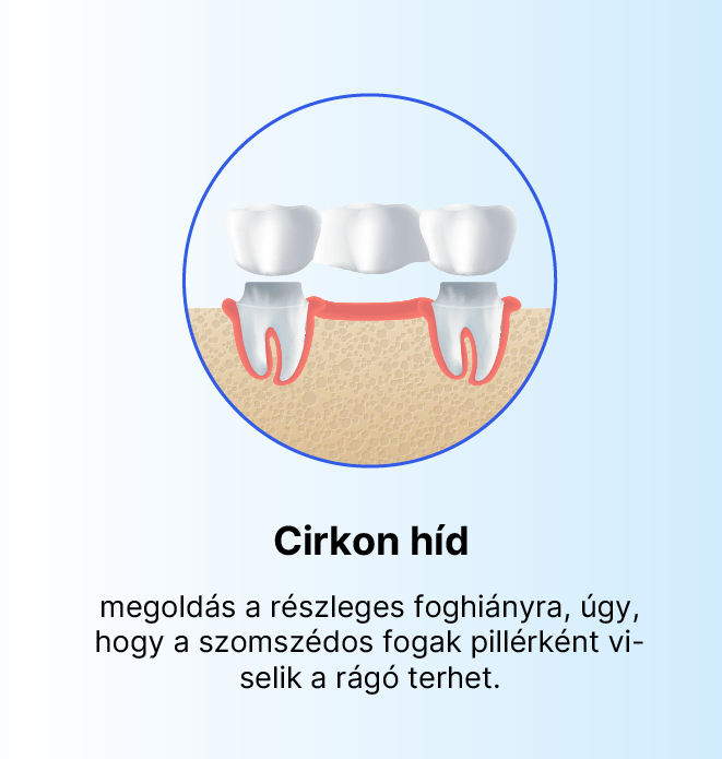 Cirkónium (zirconia) foghíd digitális CAD/CAM tervezéssel, fémmentes esztétikus fogpótlás.