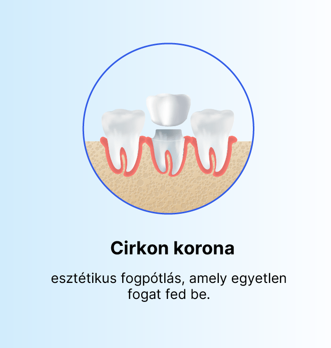 Cirkon korona digitális CAD/CAM tervezéssel, fémmentes esztétikus fogpótlás.